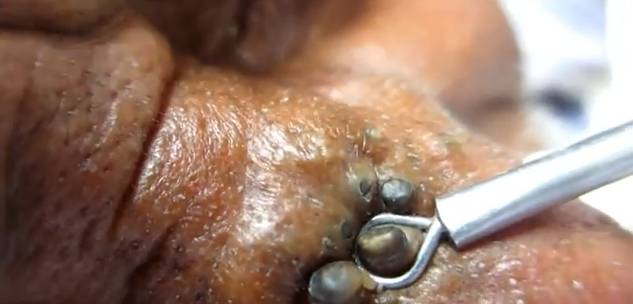 old-blackhead-removal