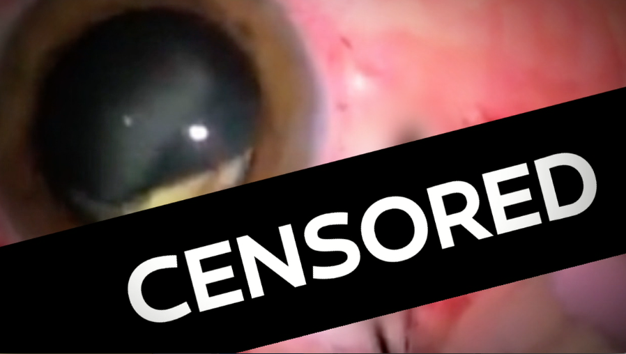 MUST WATCH Skilled Doctors Remove Foreign Object From an Eyeball RTM