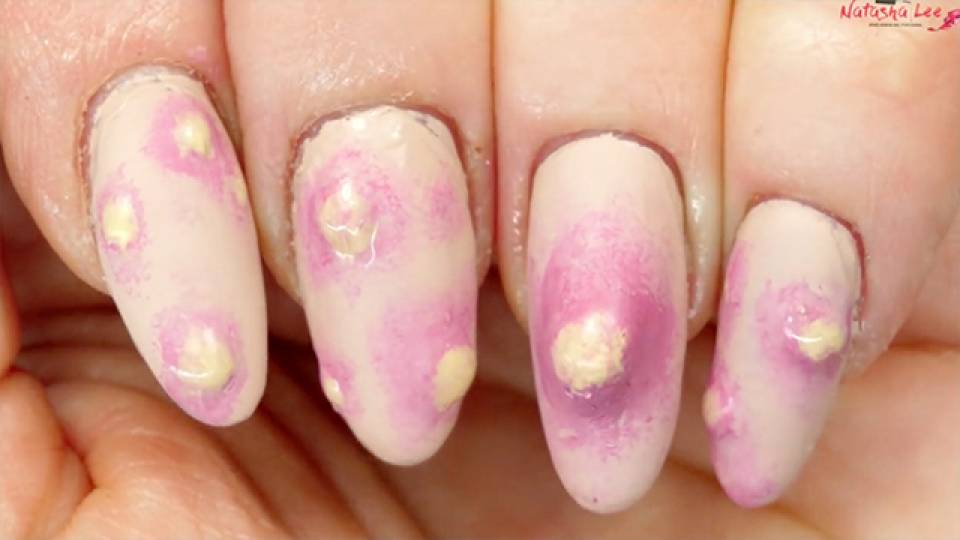 Pimple Popping Finger Nails Rtm Rightthisminute Pimple Popping Finger Nails