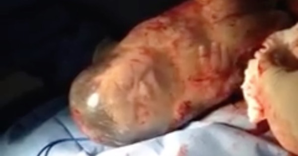 Amazing Footage of Baby Delivered While Still Inside ...